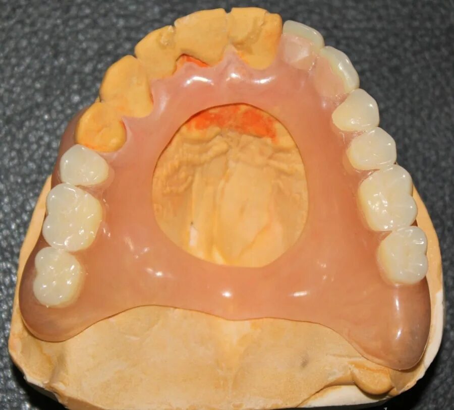 Протез на челюсть без зубов. Зубной протез на верхнюю челюсть. Частичный нейлоновый протез. Нейлоновый съемный протез. Частичный съемный протез.