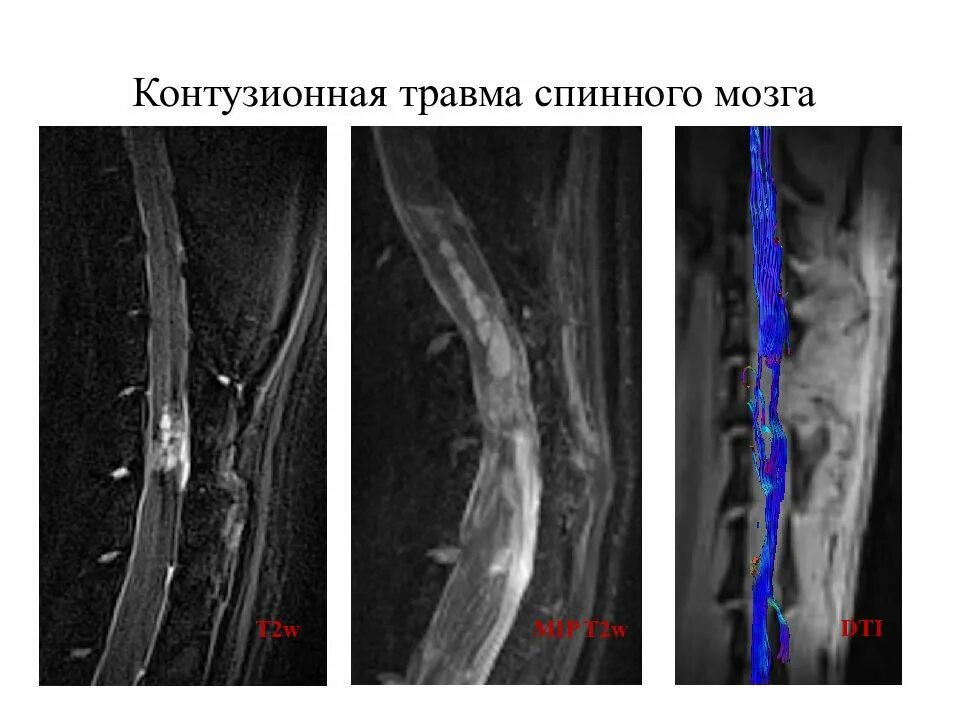 Полный разрыв спинного мозга. Травма спинного мозга снимок.