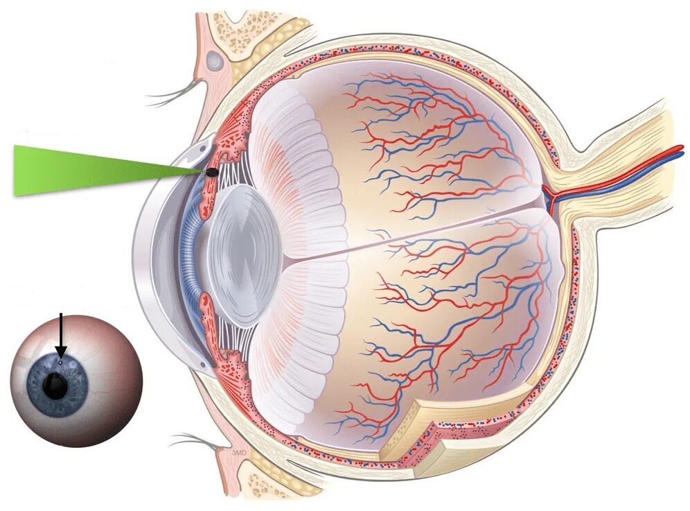 Глазная операция глаукомы. Иридотомия и иридэктомия. Преглаукома лазерная иридэктомия. Лазерная иридотомия при глаукоме. Лазерная иридотомия (иридэктомия).
