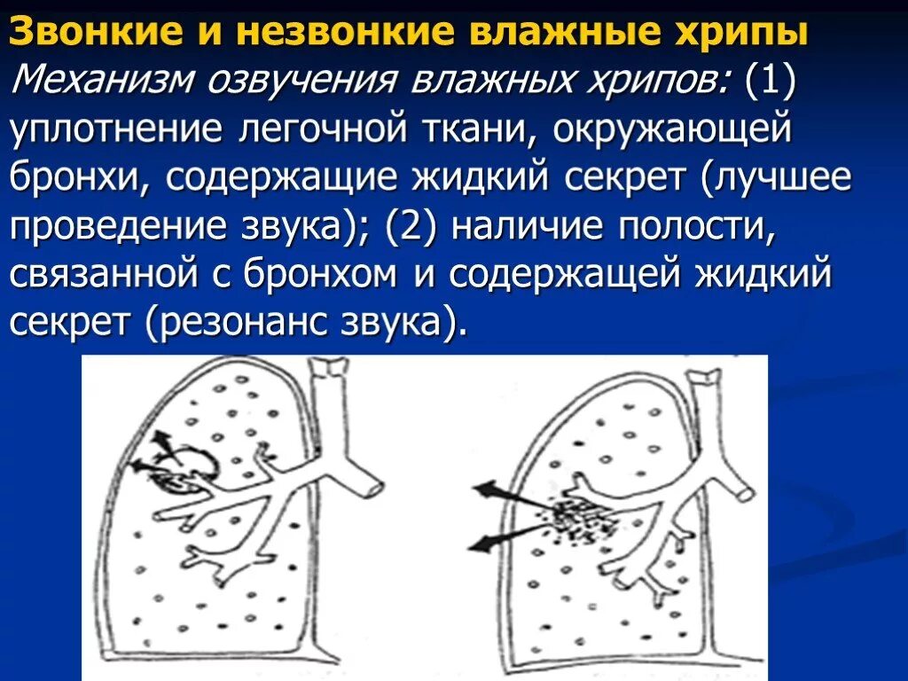 Механизм образования влажных хрипов. Хрипы в легких. Механизм возникновения влажных хрипов. Свистящие хрипы в легких. Свист при выдохе лечение