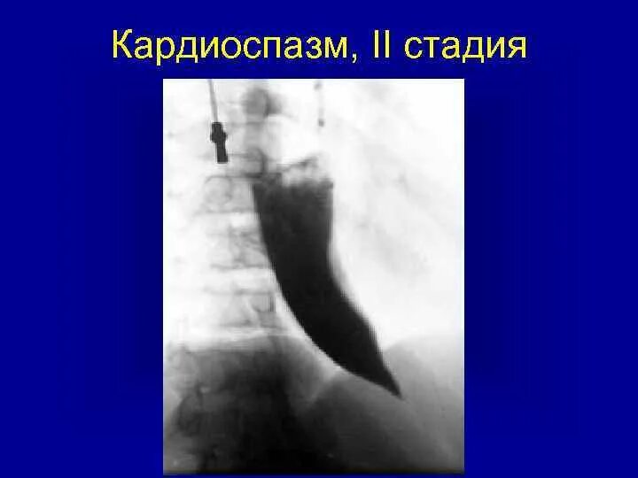 Пищевода 1 степени. Ахалазия пищевода рентген. Кардиоспазм пищевода рентген. Кардиоспазм пищевода стадии.