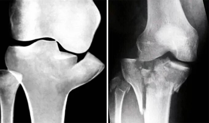 Перелом мыщелка большеберцовой кости рентген. Перелом мыщелков большеберцовой кости рентген. Импрессионный перелом большеберцовой кости на рентгене. Перелом наружного мыщелка большеберцовой кости.