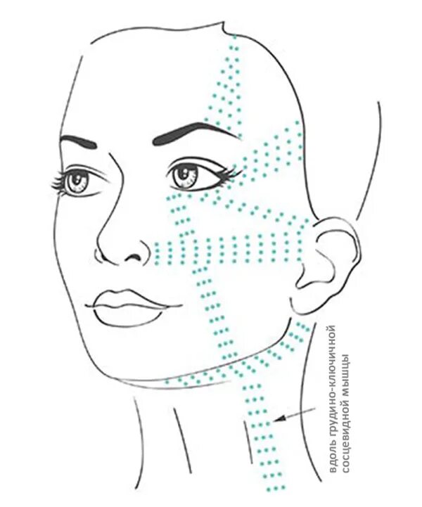 Гиалуаль биоревитализация техника введения. Схема мезотерапии ДМАЕ. Гиалуаль схема введения. Схемы инъекций ДМАЕ. Точка уколова