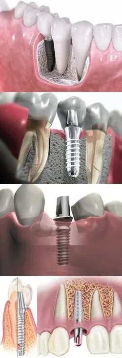 Через сколько можно вставить зубы. Этапы имплантации зубов абатмент. Зубные импланты до и после. Имплантанты коренных зубов.