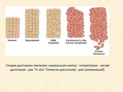 Легкая дисплазия