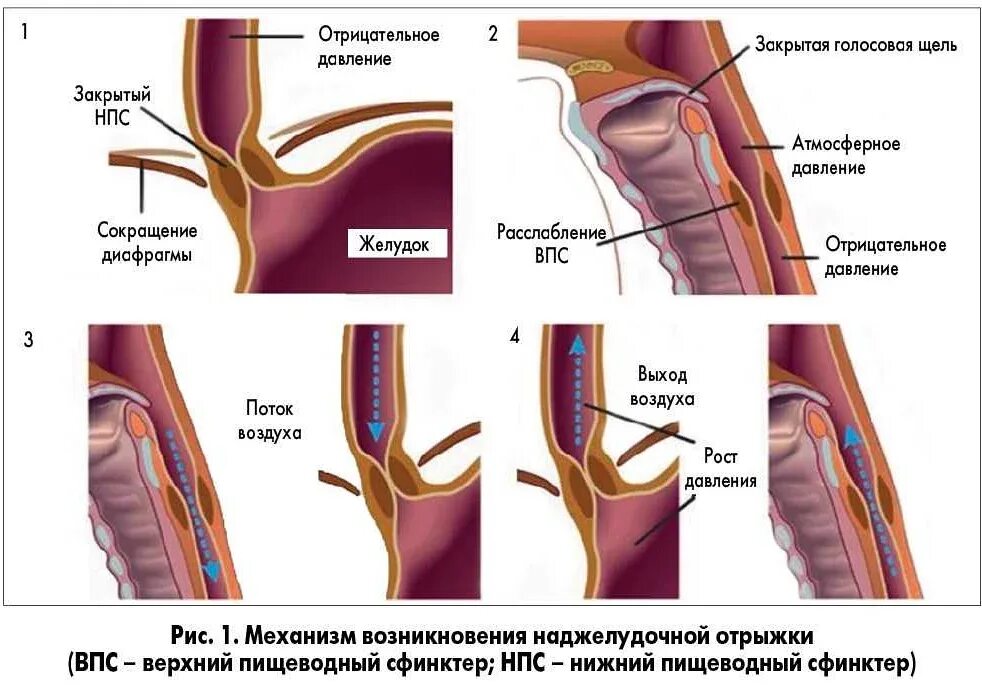 Сфинктер пищевода человека строение. Нижепишеволный сфинктер. Верхний сфинктер пищевода. Сфинктеры пищевода анатомия. Почему сфинктер