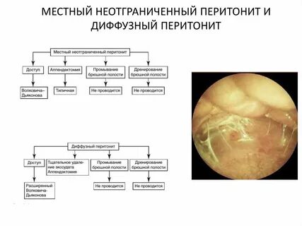 Признаки перитонита брюшной полости у женщин