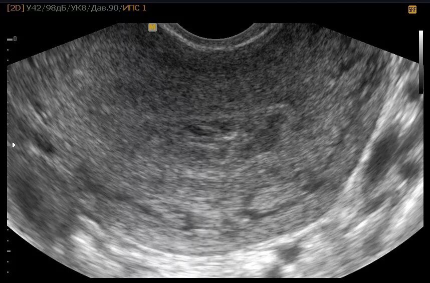 Беременность на 2-3 недели беременности на УЗИ. Снимок УЗИ 2-3 недели беременности. УЗИ матки беременность 2 недели.