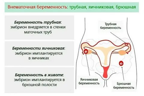Кровянистые выделения при внематочной