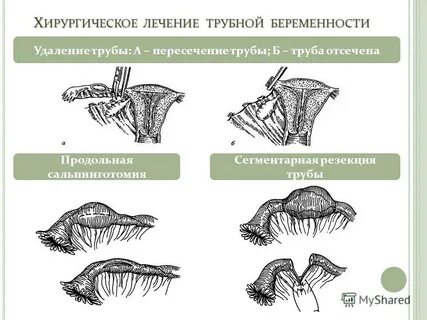Типы трубной беременности