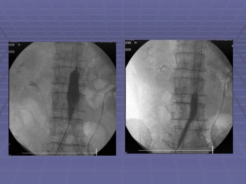 Стентирование аневризмы. Аневризма брюшной аорты стентирование. Стентирование аорты брюшной полости. Стент графт аневризма брюшной аорты. Шунтирование аорты брюшной полости.
