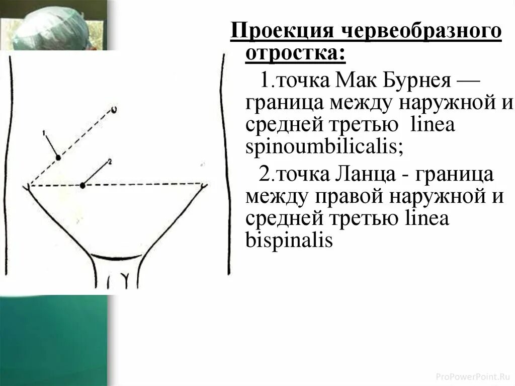 Точки аппендицита. Точка Мак Бурнея и точка Ланца. Линия Мак Бурнея и Ланца. Точка Мак Бурнея и Ланца при аппендиците. Болевые точки Мак Бурнея Ланца.