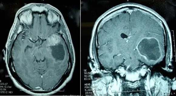 Опухоль мозга глиобластома. Опухоль головного мозга глиобластома 4. Онкология глиобластома. Неоперабельная глиома головного мозга. Глиальная опухоль головного