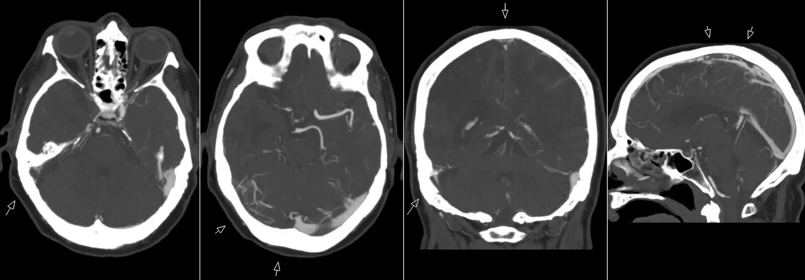 Тромбоз кавернозного синуса на кт. Тромбоз пещеристого синуса кт. Тромбоз сагиттального синуса на кт. Тромбоз на кт