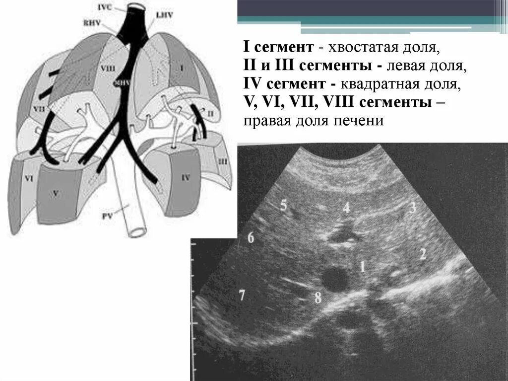 Сегменты печени на УЗИ Изранов. Сегменты печени на УЗИ схема Изранов. 1 Сегмент печени на УЗИ. 4 Сегмент печени АН УЗИ. Узи печени схема