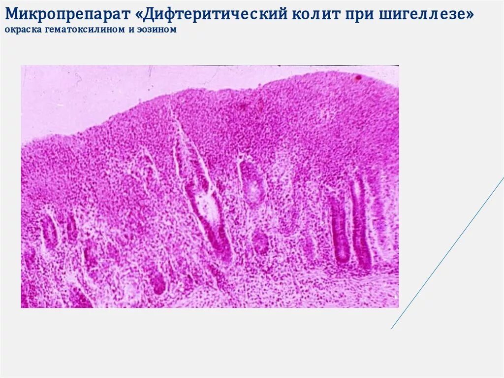 Дифтеритический язвенный колит микропрепарат. Фибринозный гастрит патологическая анатомия. Дизентерия патанатомия микропрепарат. Дифтерию патанатомия микропрепарат.