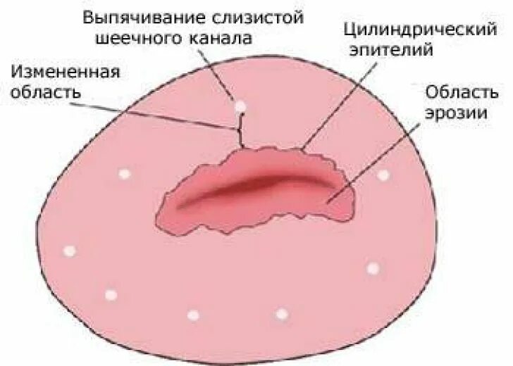 Роды эктопия. Эктопия цилиндрического эпителия шм. Роды эктопия. Роды эктопия. Петлевая конизация шейки матки.