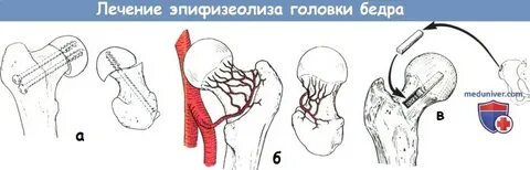 Юношеский эпифизеолиз головки