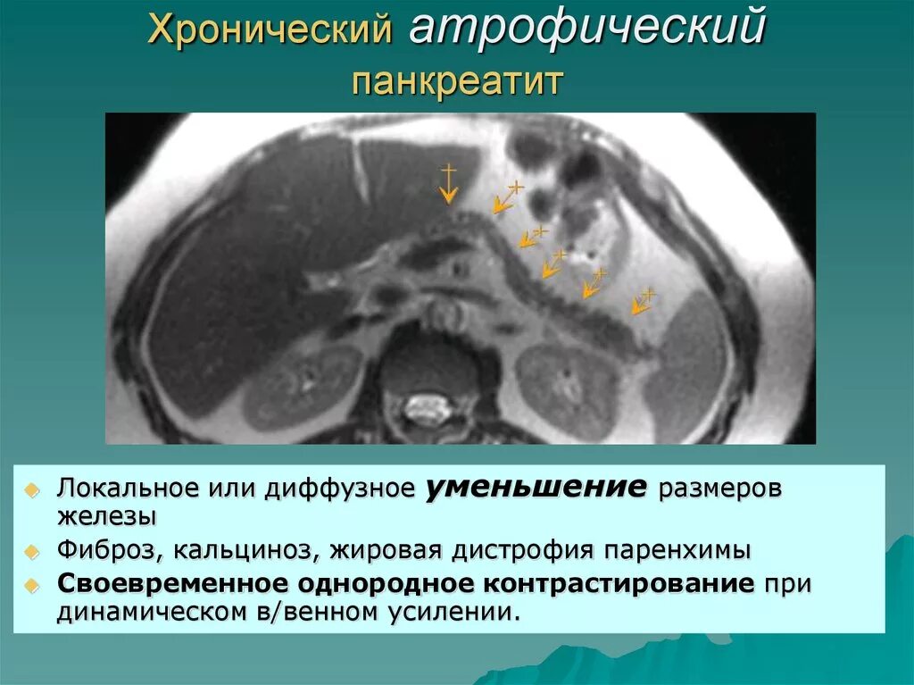 Поджелудочная железа фиброзные изменения. Кальцификация поджелудочной железы кт. Дистрофия поджелудочной железы кт. Жировая дегенерация поджелудочной железы на кт. Дистрофия поджелудочной железы мрт.