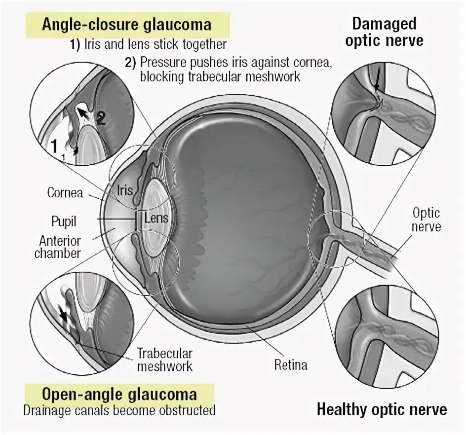 Open Angle Glaucoma. Open and closed Angle Glaucoma. Глаукома латынь