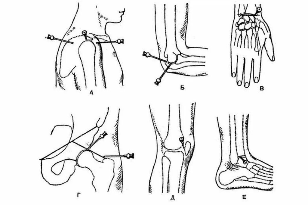 Блокада голеностопного сустава. Пункция локтевого сустава схема. Точки пункции коленного сустава топографическая анатомия. Пункция локтевого сустава точки пункции. Пункция тазобедренного сустава техника.