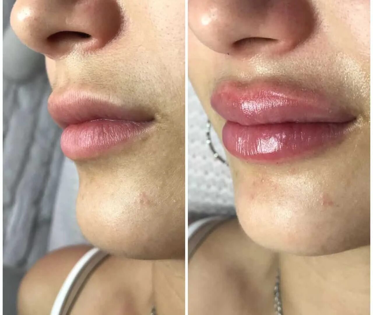 Что нельзя делать перед увеличением губ. Памятка после увеличения губ. Памятка по увеличению губ. Рекомендации после увеличения губ. Что нельзя после увеличения.