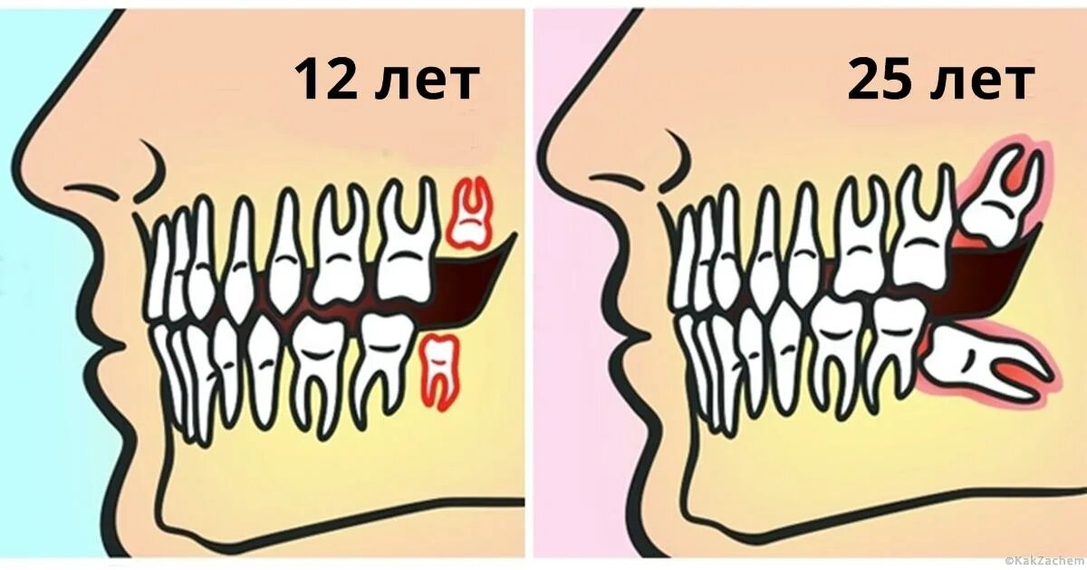 Зуб мудрости почему так назван