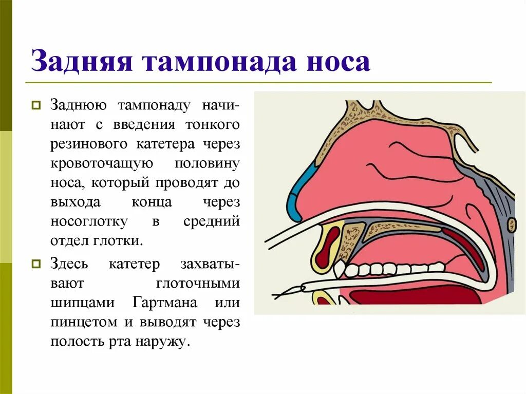 Тампонада носа при носовом кровотечении. Носовое кровотечение задняя тампонада носа. Передняя и задняя тампонада при носовом кровотечении алгоритм. Задняя тампонада полости носа алгоритм. Передняя тампонада полости носа алгоритм.