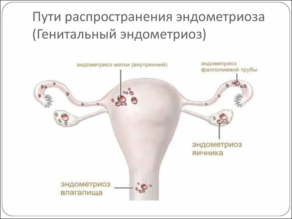 Признаки внутреннего эндометриоза на узи. Наружный эндометриоз шейки матки. По определению генитальный эндометриоз. Наружный и внутренний эндометриоз. Наружный генитальный эндометриоз классификация.