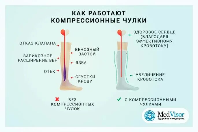 Чулки послеоперационные компрессионные. Как работают компрессионные чулки. Компрессионные гольфы после операции. Компрессионные чулки при операции. Через сколько можно снимать чулки после операции