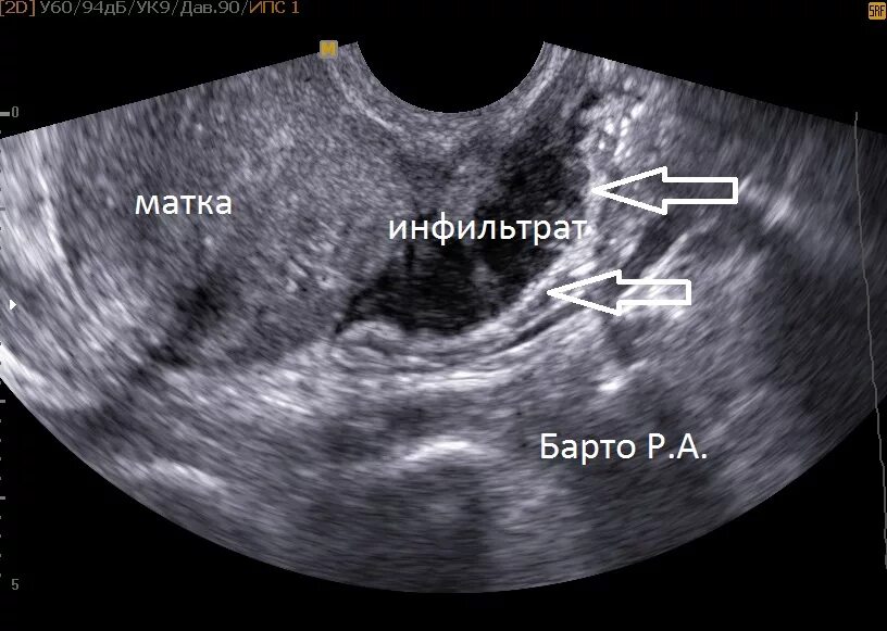 Признаки эндометриоза на узи что это. Ретроцервикальный эндометриоз на УЗИ. Эндометриоз яичника на УЗИ. Ретроцервикальный эндометриоз УЗИ картина. УЗИ картина эндометриоза матки.