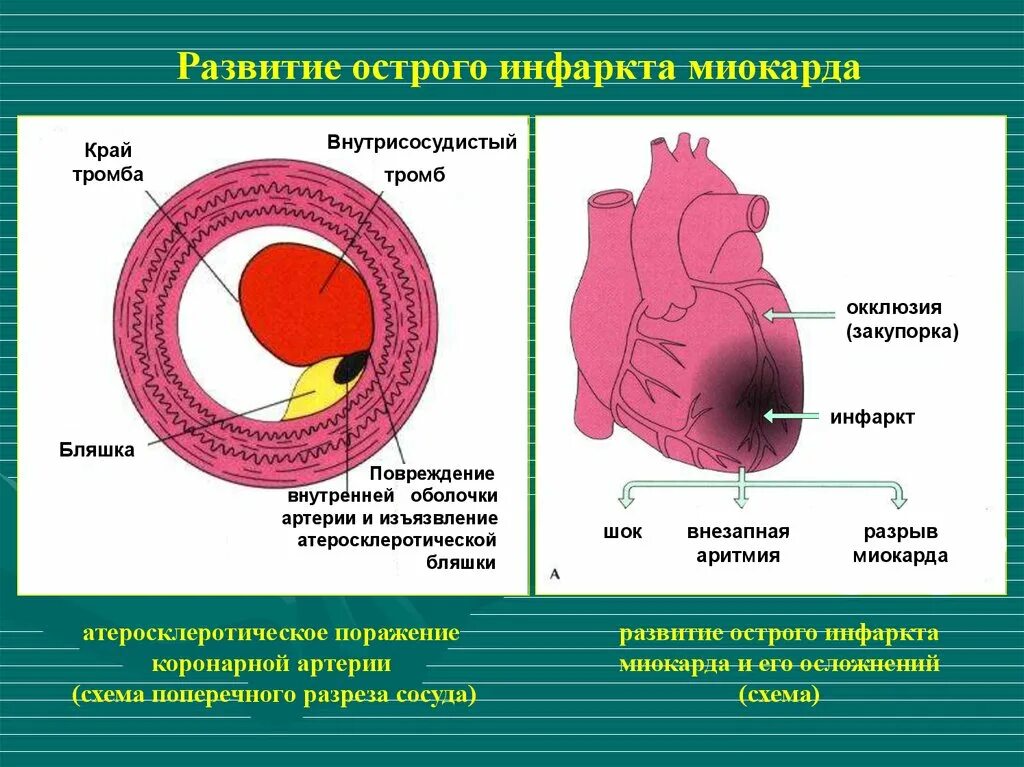 Тромб в желудочке. Образование тромба при инфаркте миокарда. Схема развития инфаркта миокарда. Острое повреждение миокарда. Сердце при инфаркте миокарда.