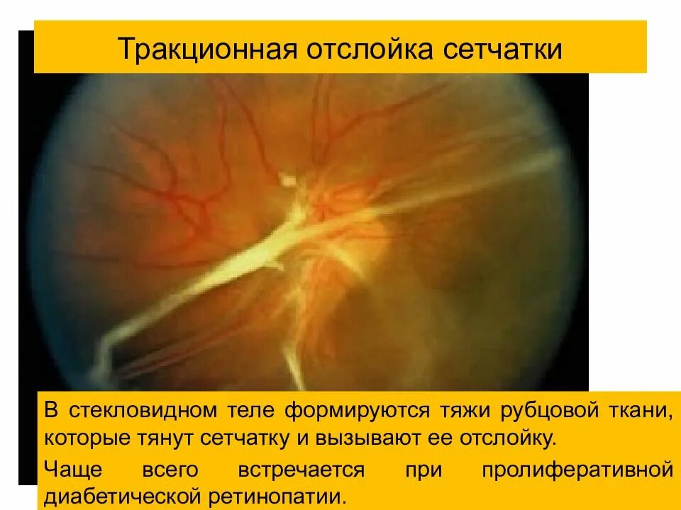 Посттравматическая отслойка сетчатки. Регматогенная отслойка сетчатки. Экссудативная отслойка сетчатки. Тракционная отслойка сетчатки глаза.