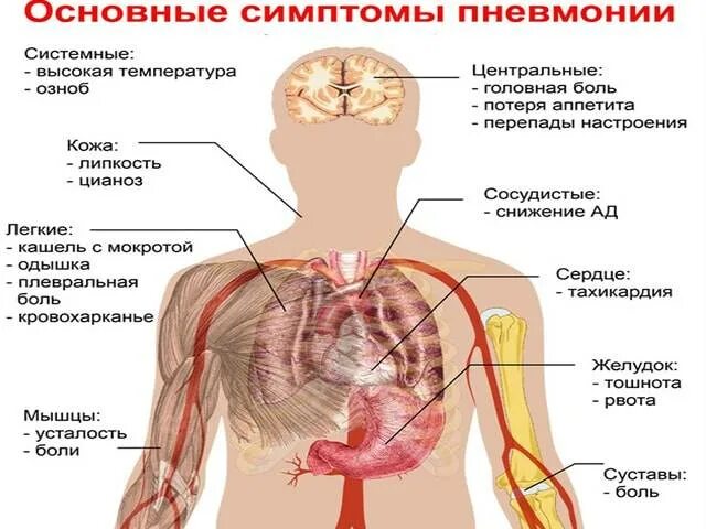 Пневмония признаки у взрослых. Основные симптомы пневмонии. Симптомы воспаления легких. Воспаление лёгких симптомы у подростков.