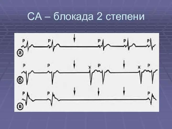 Са блокада 1 степени. Транзиторная са блокада 2 степени. Синоатриальная блокада на ЭКГ. Са блокада 3-й степени;. Са-блокада II степени, Тип i.