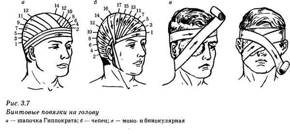 Чепец Гиппократа повязка на голову. Бинтовая повязка шапочка Гиппократа. Перевязка шапочка Гиппократа. Техника перевязки головы «шапочка Гиппократа». Давление при травме головы