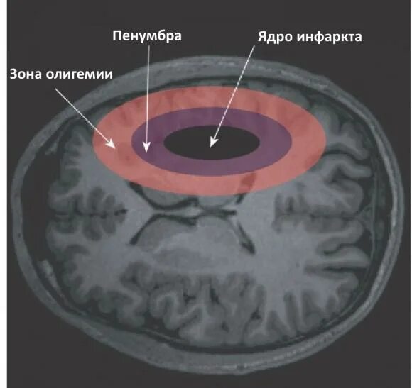 Стационарное ядро. Ишемическая полутень Пенумбра. Ишемический инсульт Пенумбра. Пенумбра зона ишемической полутени.