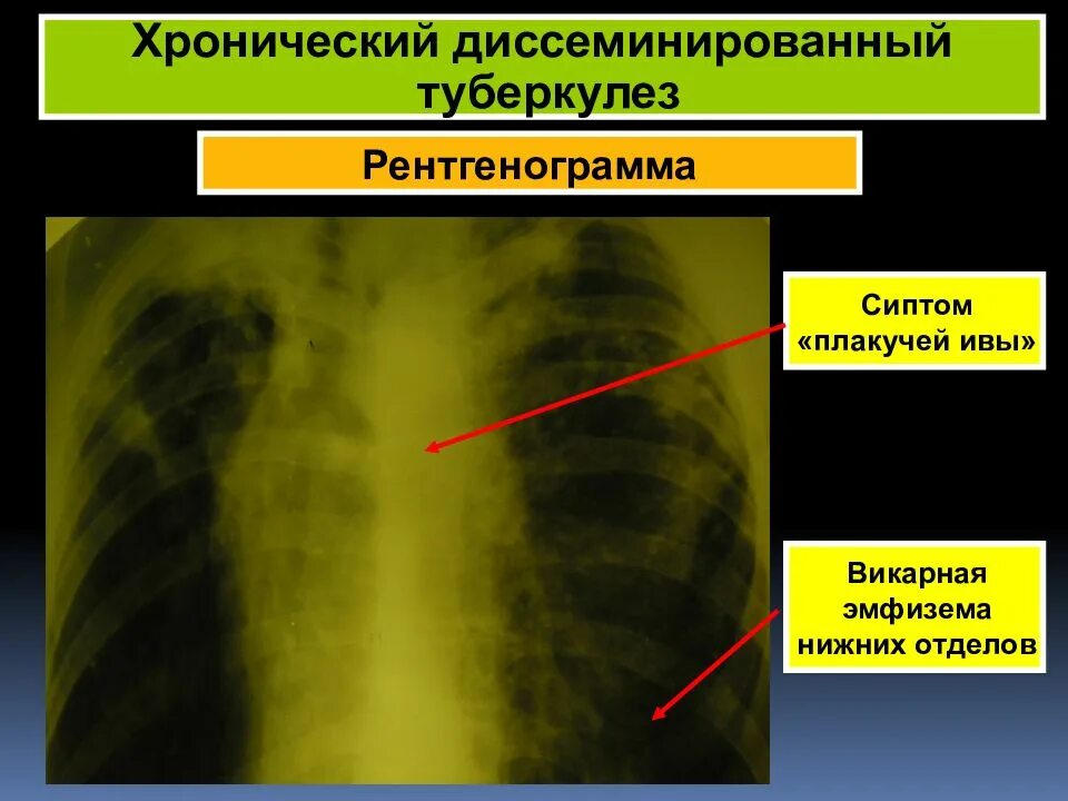 Викарная эмфизема. Викарная эмфизема. Парасептальная буллезная эмфизема. Викарная эмфизема левого легкого. Викарная эмфизема.