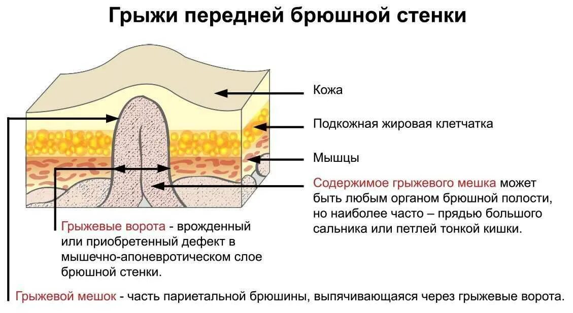 Брюшная стенка после операции. Подкожно-жировая клетчатка брюшной стенки слоя. Подкожно жировая клетчатка схема. Вентральная грыжа классификация. Жировой клетчатка передней брюшной стенки.