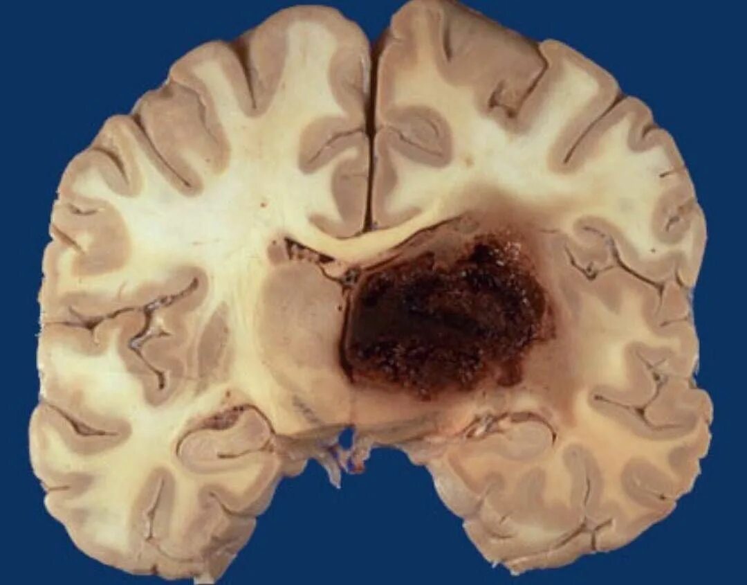Субатрофические изменения мозга. Геморрагический инфаркт головного мозга патанатомия. Ишемический инсульт макропрепарат. Ишемический инфаркт макропрепарат. Инфаркт мозга макропрепарат.