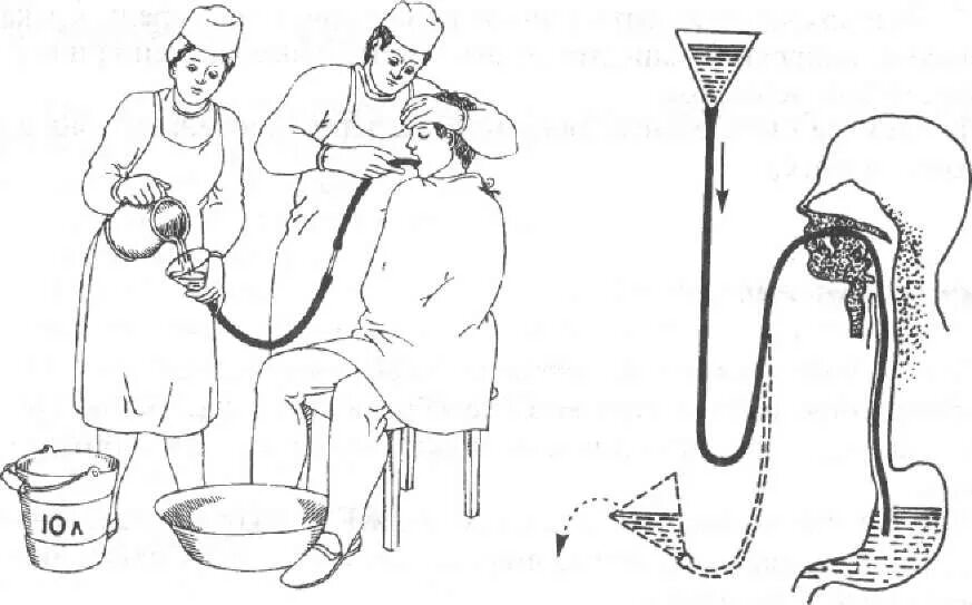 Клизма в душе. Промывание желудочного зонда алгоритм. Промывание желудка зондом алгоритм. Зондовое промывание желудка алгоритм. Техника промывания желудка зондом.