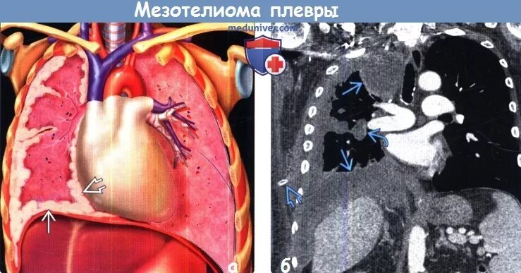Метастазы плевры. Злокачественная мезотелиома плевры кт. доброкачественная мезотелиома плевры на кт. мезотелиома диафрагмы кт. узловая мезотелиома плевры кт.