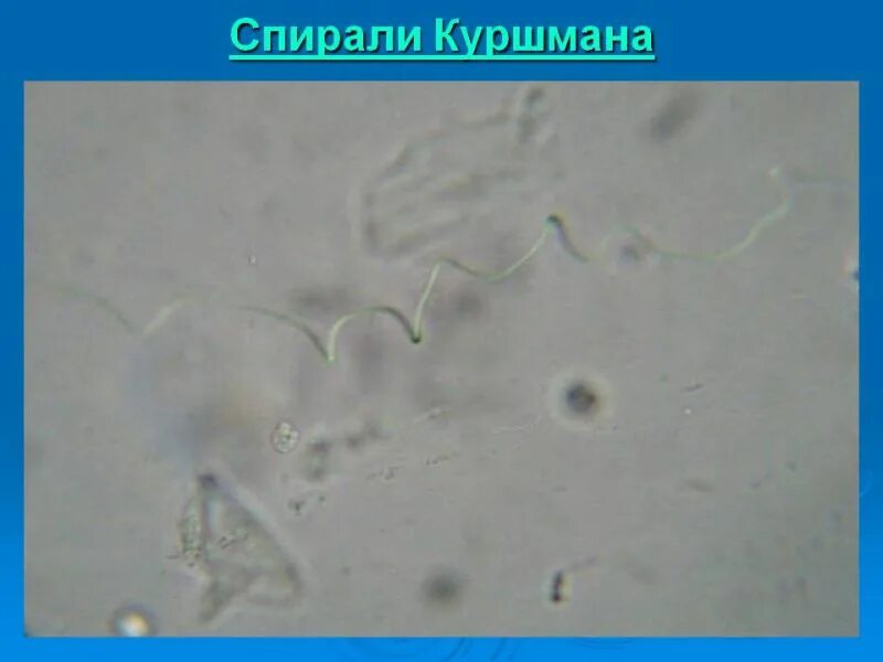 Куршмана в мокроте. Исследование мокроты спирали Куршмана. Спирали Куршмана в мокроте под микроскопом. Спирали Куршмана в мокроте. Кристаллы Шарко и спирали Куршмана.