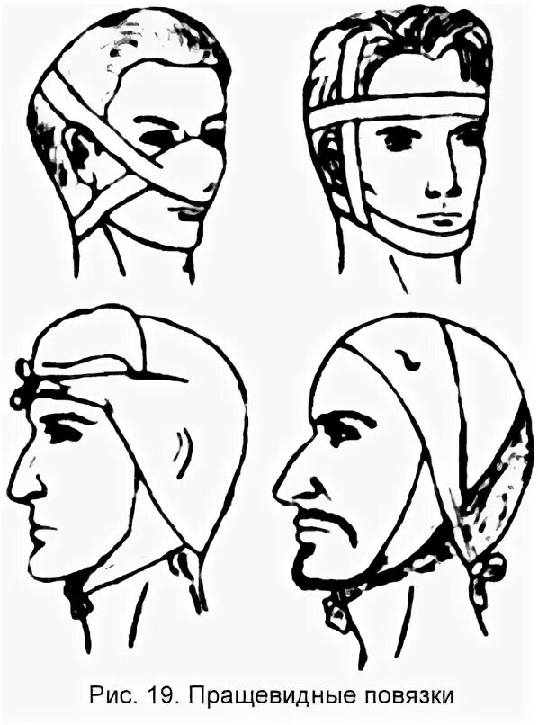 Техника наложения пращевидной повязки. Пращевидная повязка медицинский. Десмургия пращевидная повязка. Пращевидная повязка на затылок.
