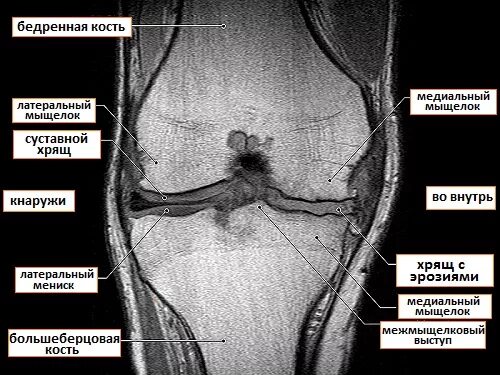 Гонартроз коленного сустава мрт. Гонартроз коленного сустава мрт. Артроз коленного сустава мрт снимок. Капсулит коленного сустава мрт. Мрт большеберцовой кости.