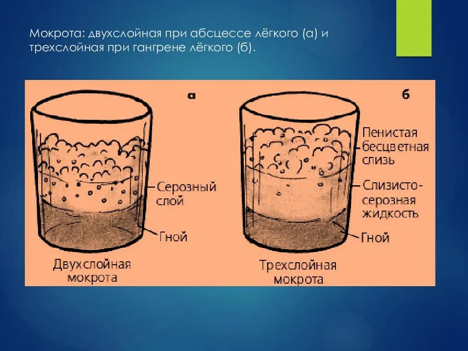 Мокрота при абсцессе легкого. 3 Слоя мокроты при абсцессе. Мокрота при абсцессе и гангрене легкого. Мокрота при гангрене легкого. Абсцесс легкого мокрота.