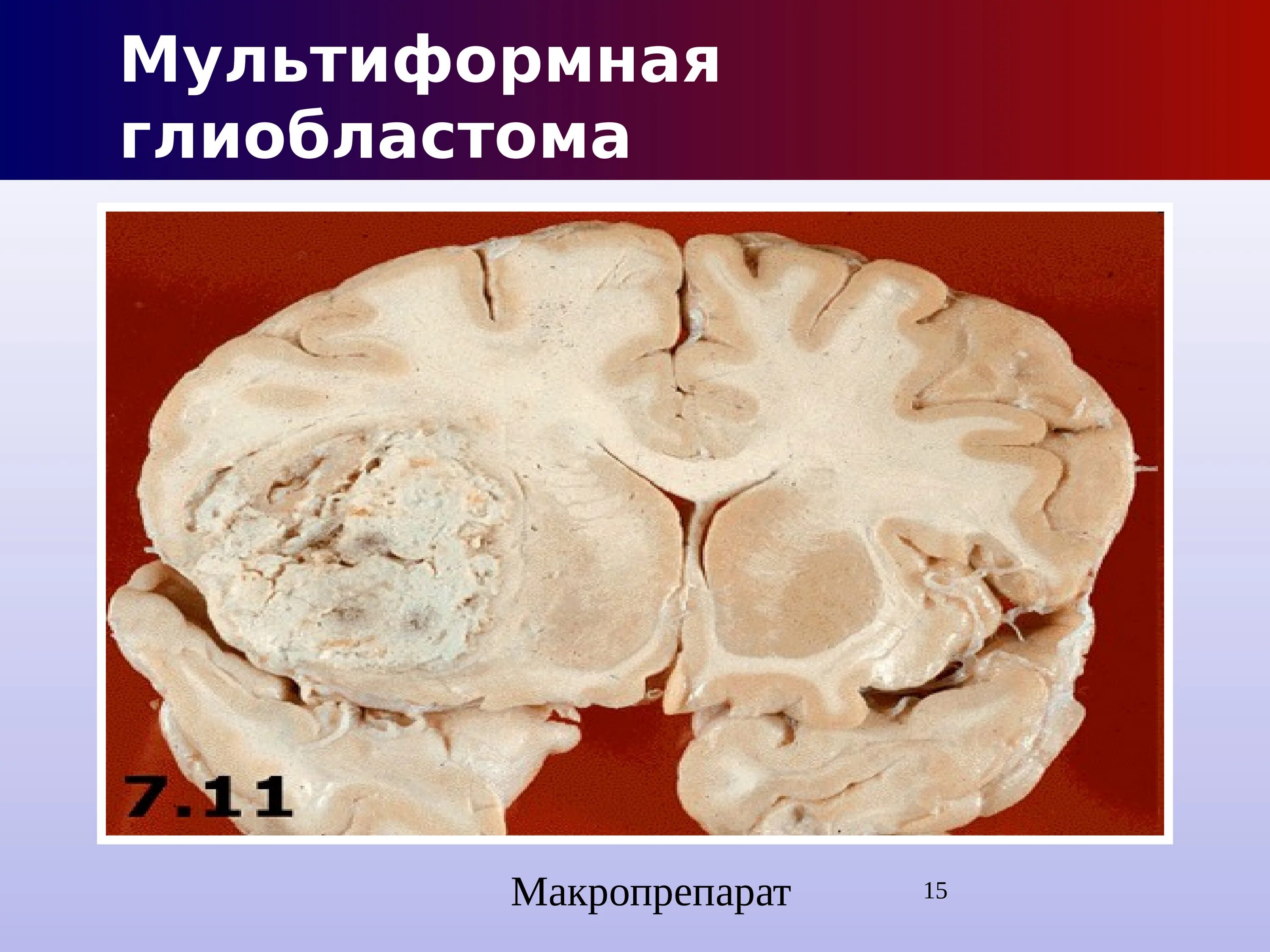 Рак мозга сколько стадий. Мультиформная глиобластома макропрепарат. Гигантоклеточная глиобластома. Глиобластома мозжечка гистология.