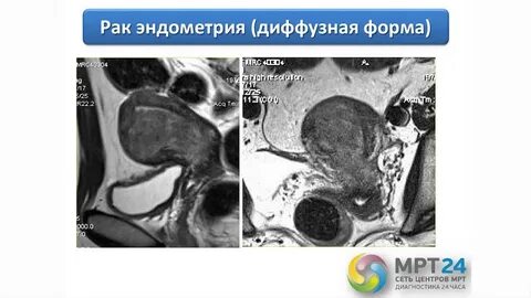 Мрт эндометрия