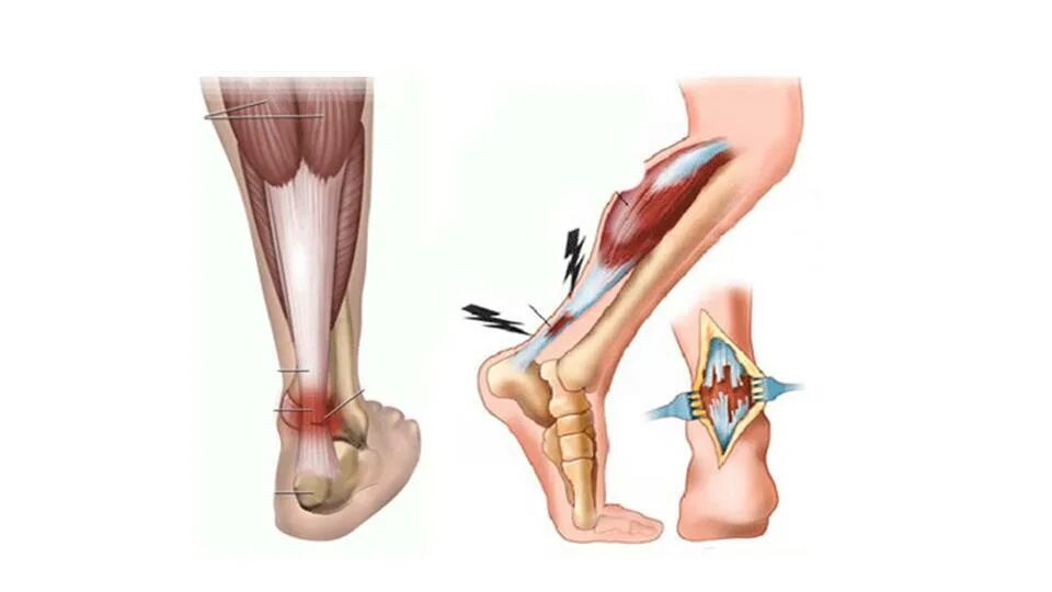 Связка ахиллова сухожилия. Ахиллово сухожилие растяжение. Бурсит ахиллова сухожилия в пятке. Тендопатия ахиллесова сухожилия. Бег болит пятка