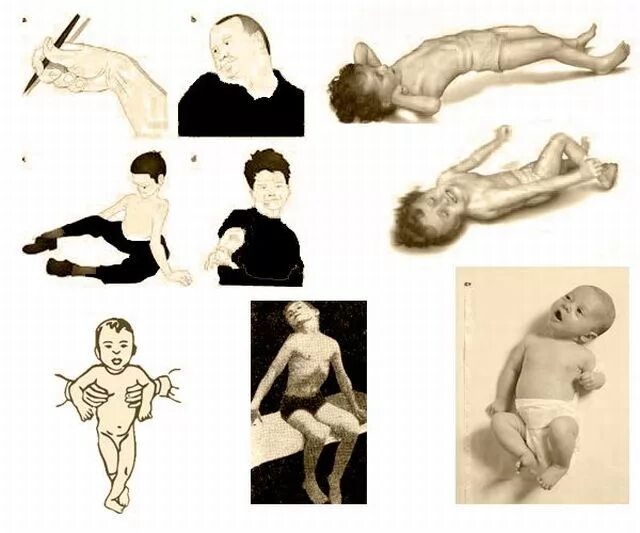Мышечный синдром симптомы. Дистонический мышечный тонус у грудничка. мышечная дистония у грудничка 6 месяцев. синдром мышечная дистония. мышечный тонус дистония у новорожденных что это.